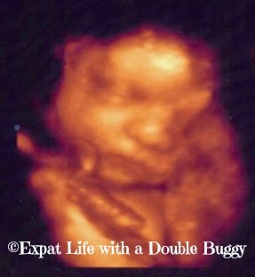 91bc7-babyscan Home Births: Let Pregnant Women Decide
